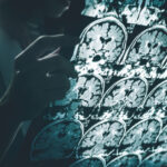 AB, tarihi Alzheimer ilacına ruhsat vermedi: Faydası, riskleri görmezden gelecek kadar değil - Haberler | Sağlık Haberleri