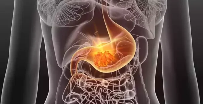 Mide Kanserine Ne İyi Gelir? Doğal ve Tıbbi Çözümler