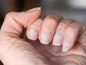 Demir Eksikliği Nedir? Belirtileri, Nedenleri ve Doğal Tedavi Yöntemleri