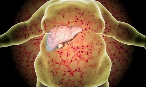 Karaciğer Yağlanması Nedir? Nedenleri, Belirtileri ve Korunma Yolları
