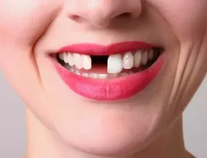 Rüyada Diş Dökülmesi Görmek Ne Anlama Gelir?