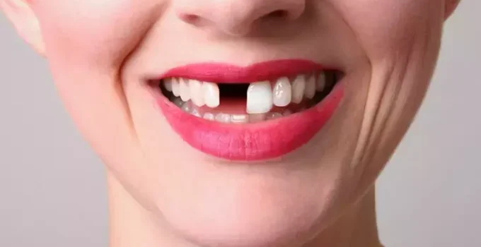 Rüyada Diş Dökülmesi Görmek Ne Anlama Gelir?