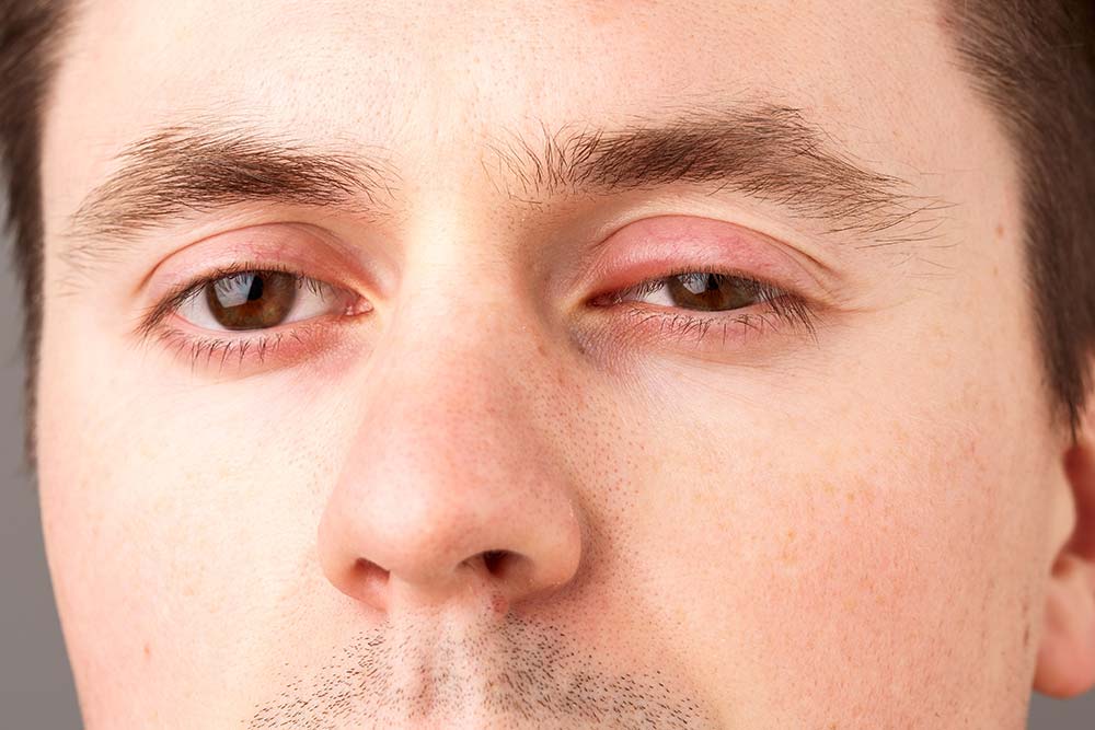 Hordeolum,On,Man.,Infection,At,The,Lower,Eyelid.,The,Inflammation