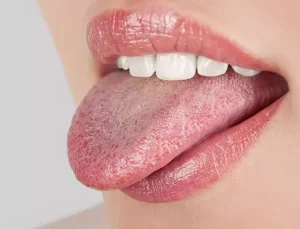 Dil Uyuşması Neden Olur? 2025 Güncel Sebepler ve Dikkat Edilmesi Gerekenler