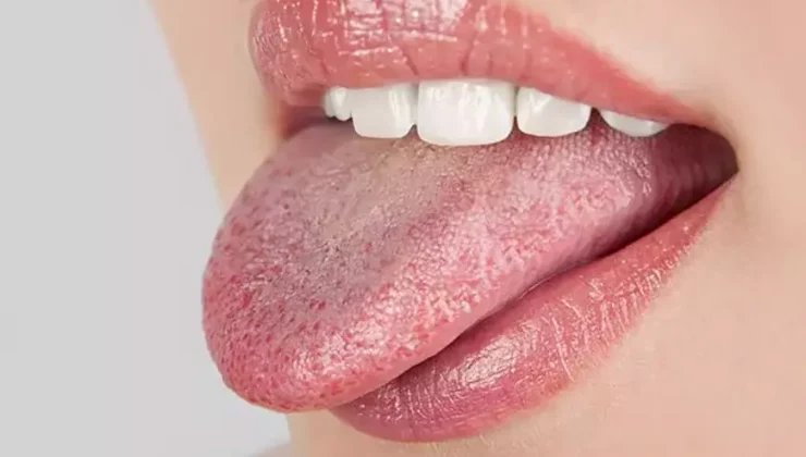 Dil Uyuşması Neden Olur? 2025 Güncel Sebepler ve Dikkat Edilmesi Gerekenler